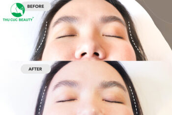 Cấy mỡ thái dương trẻ hóa 