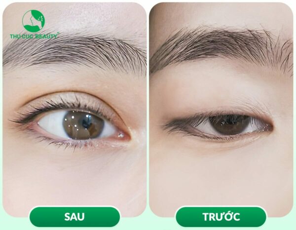 Phẫu thuật sụp mí mắt giúp tăng vẻ thẩm mỹ cho gương mặt, cải thiện thị lực, góp phần nâng cao chất lượng cuộc sống.