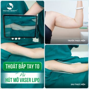 Hút mỡ thon gọn bắp tay – Giải pháp đẩy lùi mỡ thừa vùng tay hiệu quả