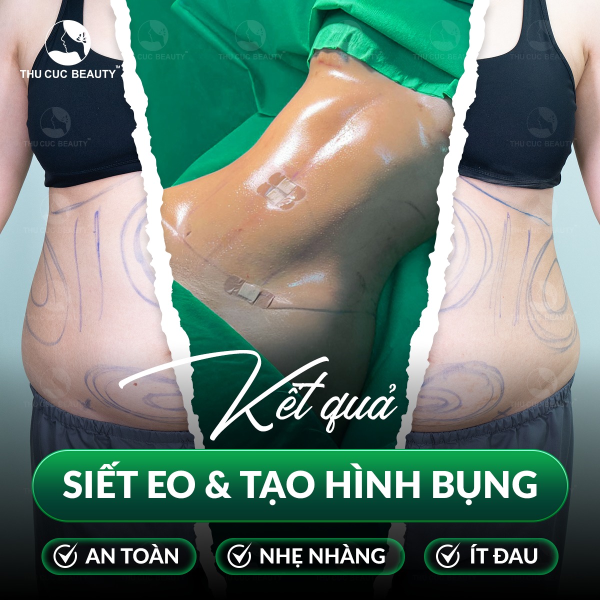 Hút mỡ tạo hình thành bụng trả lại eo thon nhanh chóng.