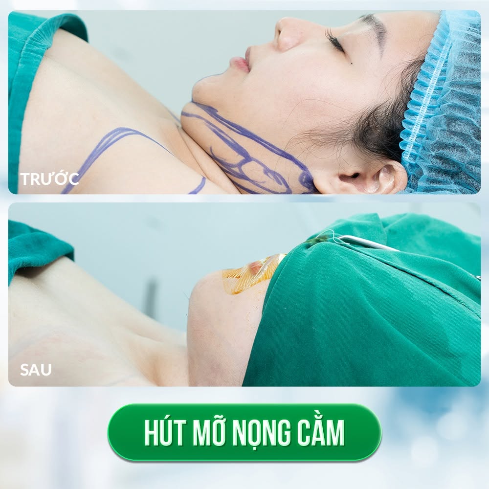 Thon gọn nọng cằm là phương pháp sử dụng công nghệ hút mỡ chuyên dụng, loại bỏ lượng mỡ dư thừa vùng cằm.