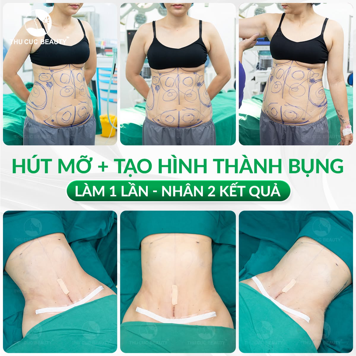 Hút mỡ tạo hình thành bụng trả lại eo thon nhanh chóng.