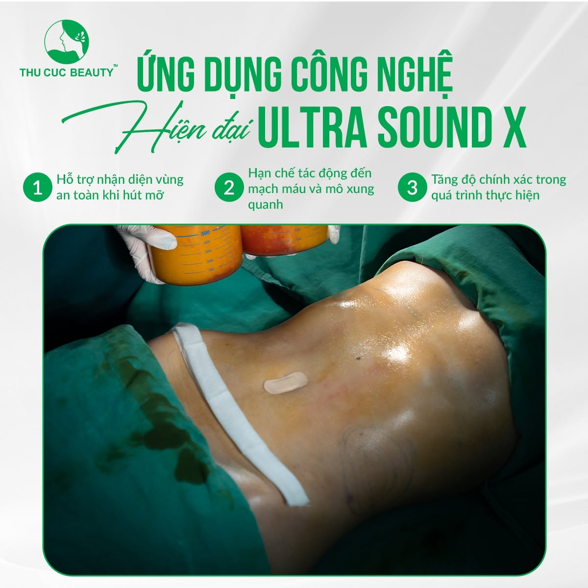 Hút mỡ bằng công nghệ Ultra Sound X kết hợp tạo hình thành bụng.