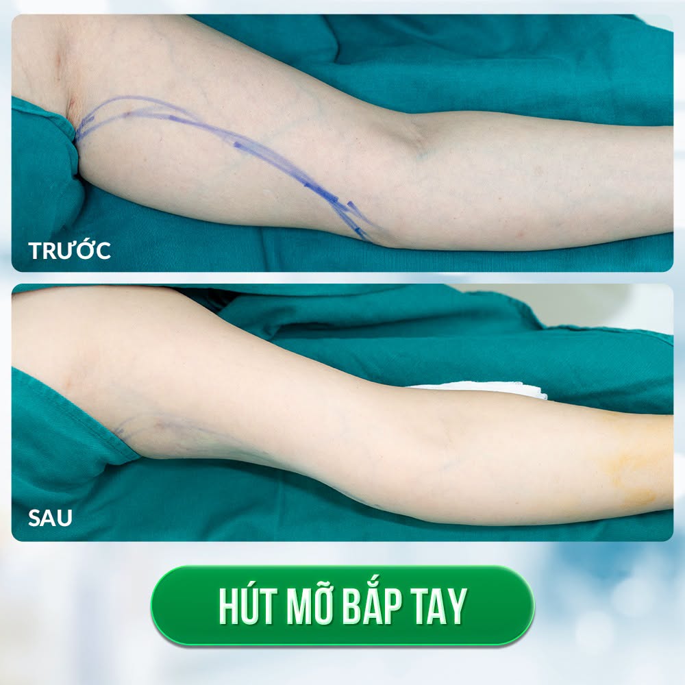 Hút mỡ thon gọn bắp tay giúp loại bỏ mỡ thừa nhanh chóng