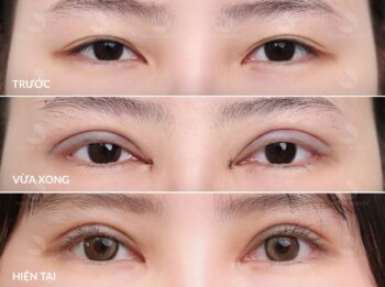 Mở rộng góc mắt tạo mắt to tròn