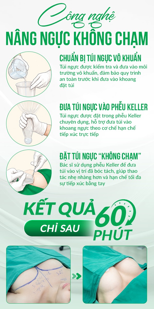 Phương pháp nâng ngực không chạm giúp hạn chế tình trạng xuất hiện bao xơ ngực
