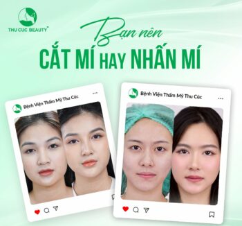 Nhấn mí: Bí quyết sở hữu đôi mắt to tròn ít xâm lấn