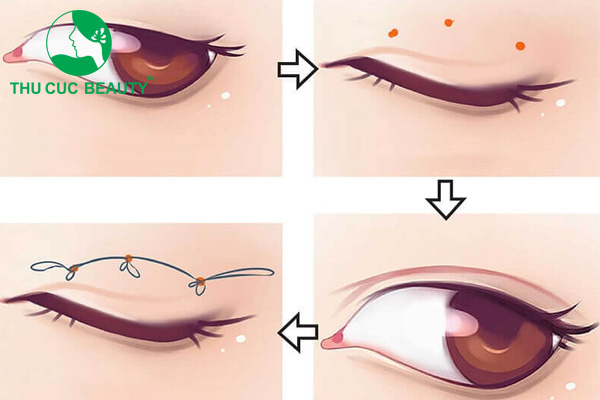 Nhấn mí mắt là thủ thuật không để lại sẹo, thời gian hồi phục nhanh chóng.