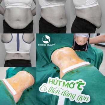 Tạo hình thành bụng và những điều cần biết