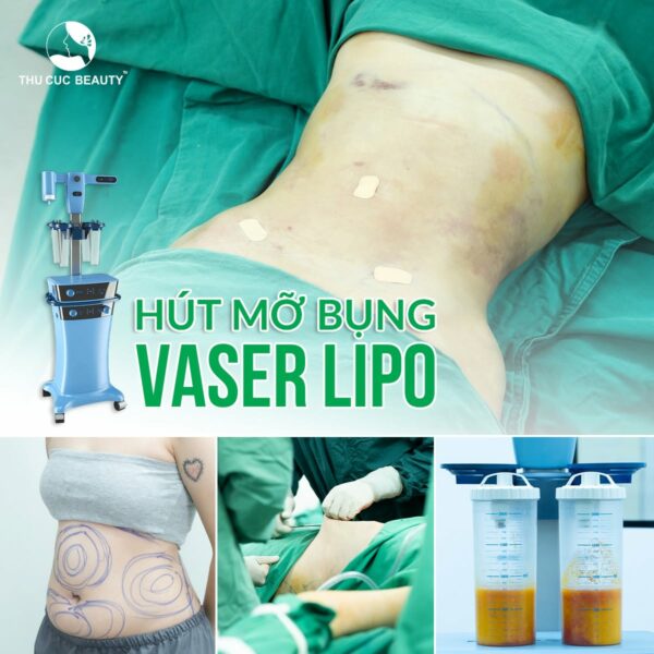 Cấy mỡ thái dương sử dụng mỡ thừa ở vị trí khác như bụng, đùi,... mang lại vẻ đẹp tự nhiên.