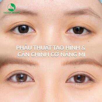 Phẫu thuật tạo hình sụp mí bẩm sinh 