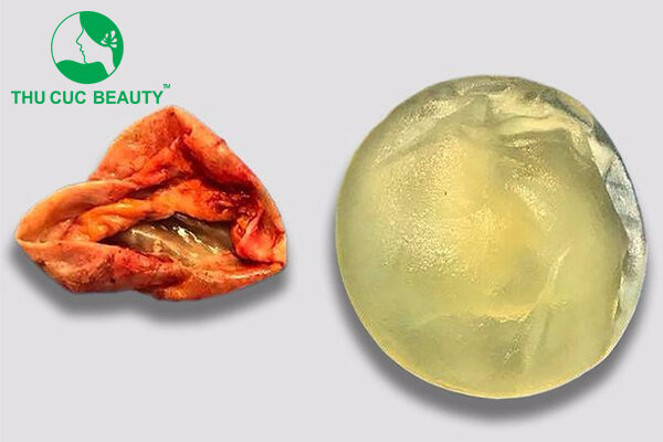 Bóc bao xơ ngực