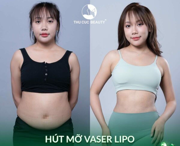 Thu gọn bụng là phương pháp thẩm mỹ giúp loại bỏ mỡ thừa ở bụng nhanh chóng.