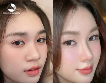 Thu nhỏ nền mũi và những điều cần biết