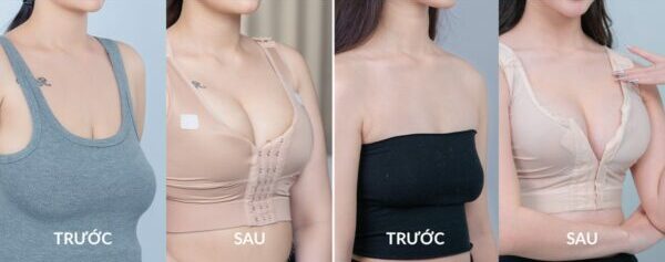 Treo Ngực Sa Trễ | Nâng Ngực Chảy Xệ
