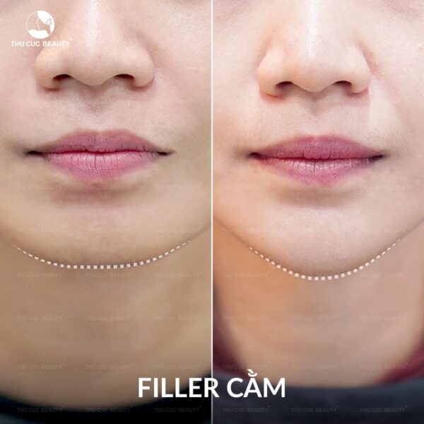 Tiêm filler cằm