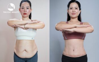 Căng da bụng và những thắc mắc thường gặp
