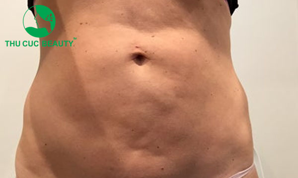 Hút mỡ bụng bị lồi lõm