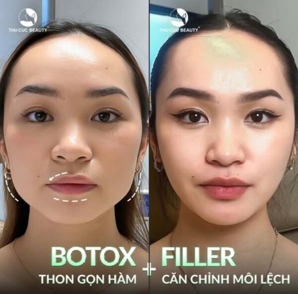 Vừa tiêm filler vừa tiêm botox vẫn được, nhưng cần thực hiện bởi bác sĩ chuyên môn.