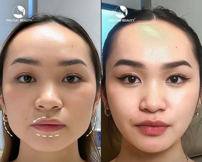 Tiêm botox và những điều cần biết