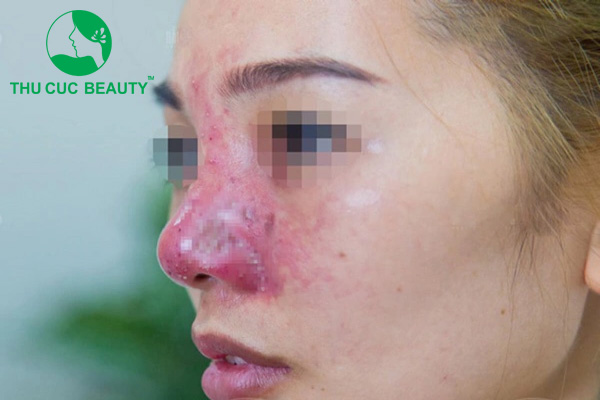 Dấu hiệu nâng mũi bị nhiễm trùng