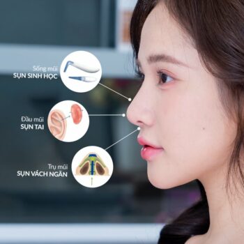 Khi nào cần nâng mũi bọc sụn? Không bọc sụn có sao không?