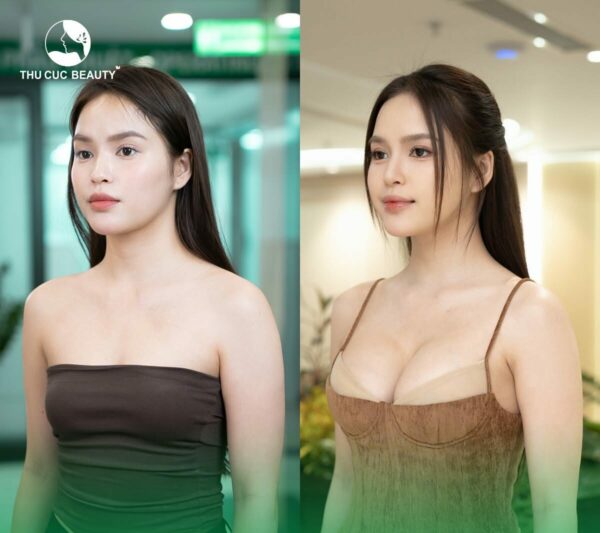 Việc quyết định nâng ngực trước khi sinh con hay không cần được cân nhắc kỹ lưỡng, dựa trên nhiều yếu tố. 