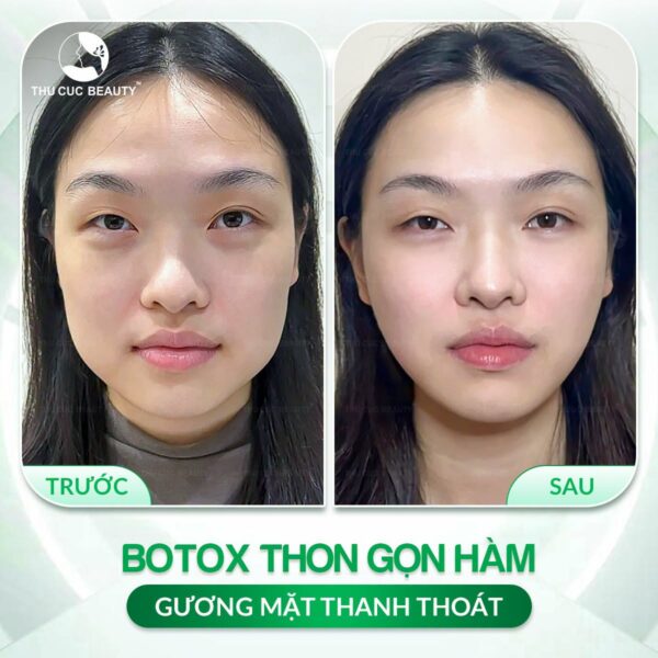 Tiêm botox gọn hàm nhiều lần có sao không?