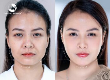 So sánh tiêm filler và cấy mỡ tự thân, nên chọn phương pháp nào?