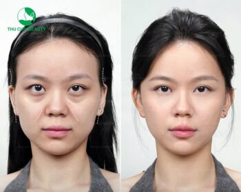 Sau khi tiêm filler bao lâu thì mềm?