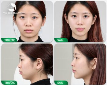 Những điều cần biết khi tiêm filler cằm
