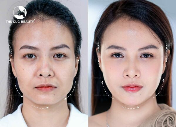 Tiêm filler giúp gương mặt đầy đặn, trẻ trung