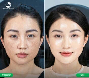 Tiêm Meso căng bóng da có hiệu quả không? Cần lưu ý những gì?