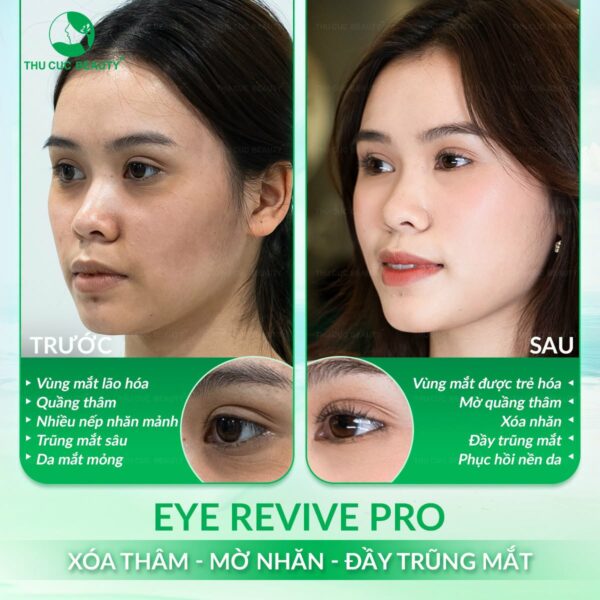 Trị thâm mắt với phương pháp Eye Revive Pro sử dụng tinh chất DNA cá hồi