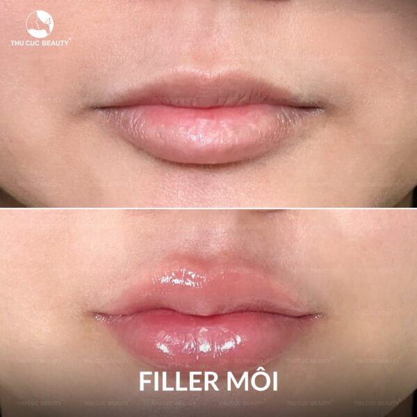 Dáng môi tiêm filler đẹp