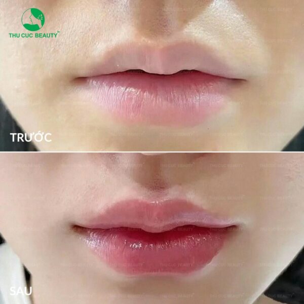 Dáng môi tiêm filler đẹp