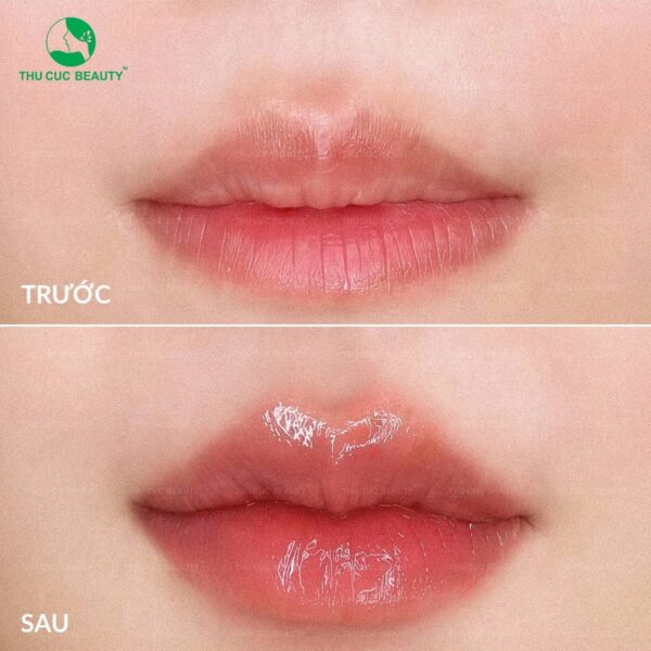 Dáng môi tiêm filler đẹp