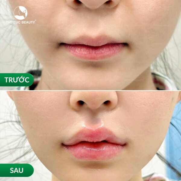 Dáng môi tiêm filler đẹp