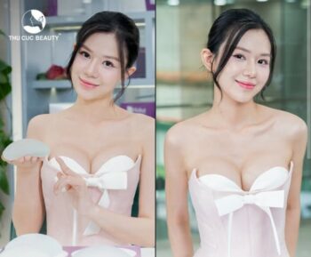 Nâng ngực xong có bị xệ không? Nguyên nhân và cách phòng tránh