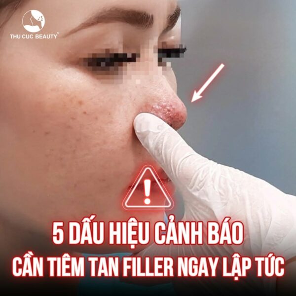 Dấu hiệu tiêm filler bị hoại tử