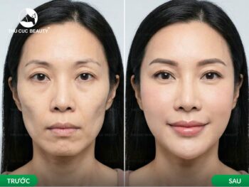Tiêm filler làm đầy má hóp cần bao nhiêu CC? 