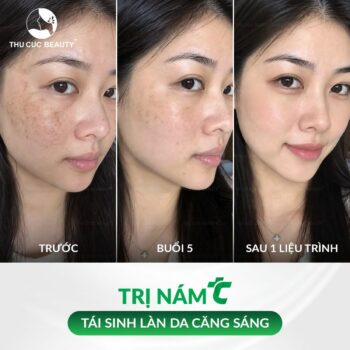 Bắn laser trị nám bao lâu thì hết?