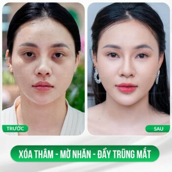 Làm đầy vùng mắt dưới: Nên tiêm filler hay cấy mỡ tự thân?