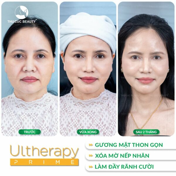 Làm đẹp bằng công nghệ Ultherapy và những điều cần biết