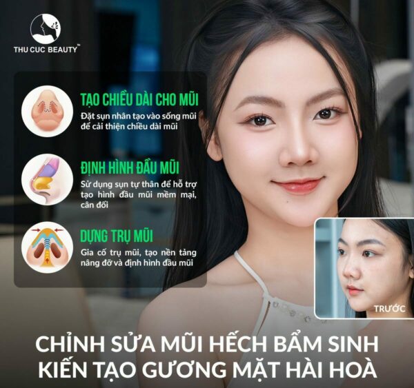 Nâng mũi cấu trúc khắc phục khuyết điểm mũi hếch