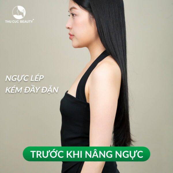 Nâng ngực giúp tăng size vòng 1 một cách hiệu quả.