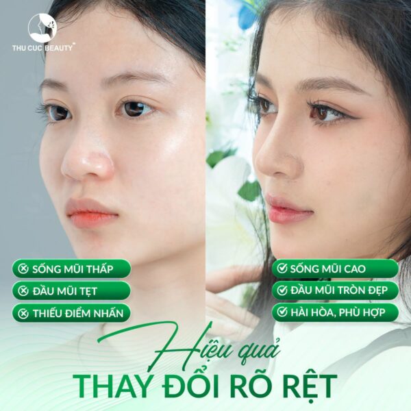 Nâng sống mũi đẹp, thanh thoát