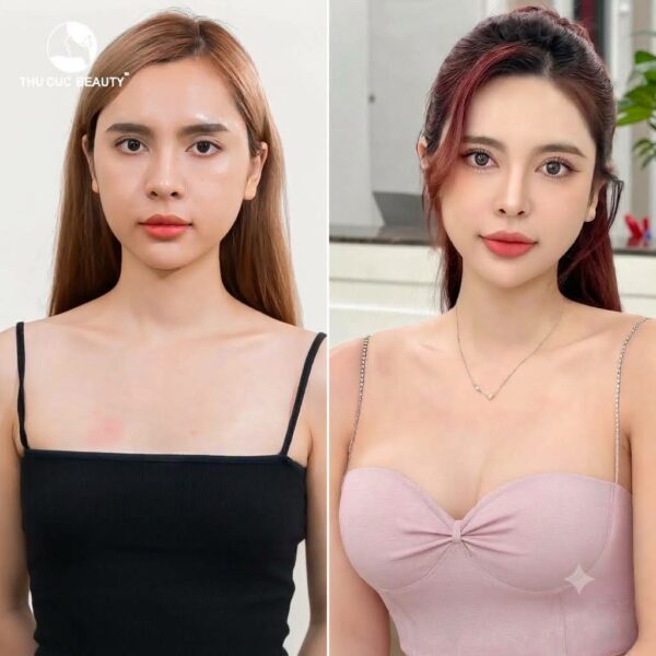 Ngực lép có nên nâng ngực không? Câu trả lời là có nếu bạn mong muốn cải thiện khuyết điểm của ngực.