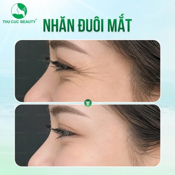 Tiêm botox xóa nhăn mắt đem lại hiệu quả tốt nếu được thực hiện tại cơ sở uy tín.
