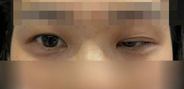 Tiêm botox xóa nhăn đuôi mắt bị sụp mí mắt do người tiêm không có kỹ thuật chuyên môn.